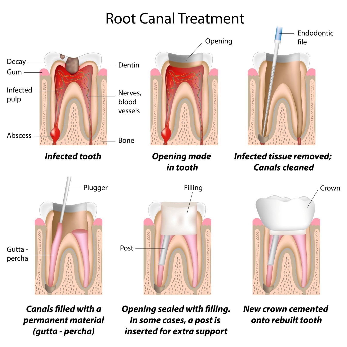  Root Canal Treatment 